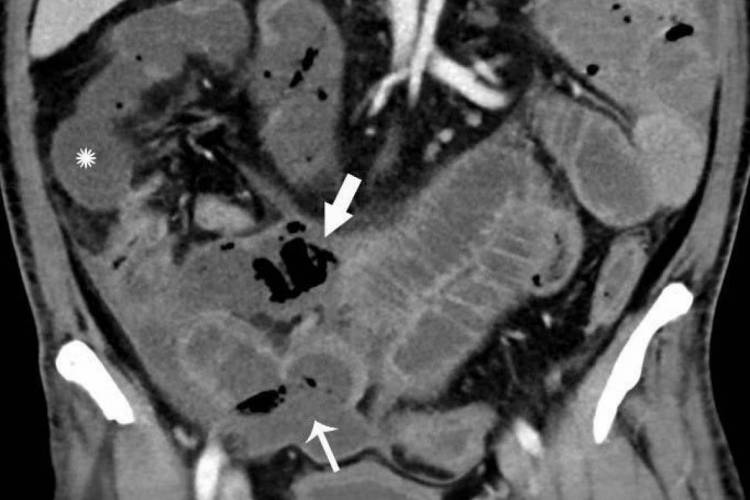 Homem de 47 anos de idade com sensibilidade abdominal apresenta características de isquemia e infarto mesentérico 