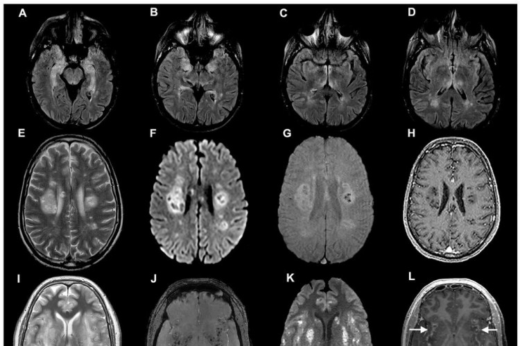 Diversas pesquisas têm investigado como o Sars-Cov-2, causador da Covid-19, afeta o cérebro. Na imagem, varreduras cerebrais de pacientes com coronavírus de um estudo publicado em julho. 