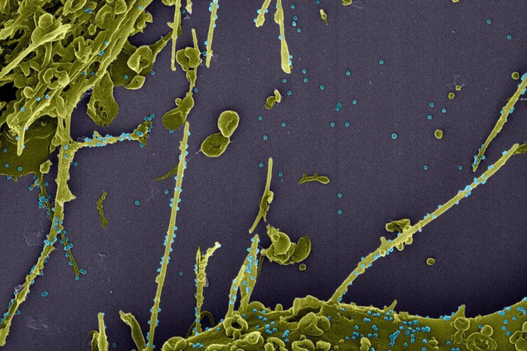 Estudo constata infecção simultânea por duas linhagens do coronavírus 