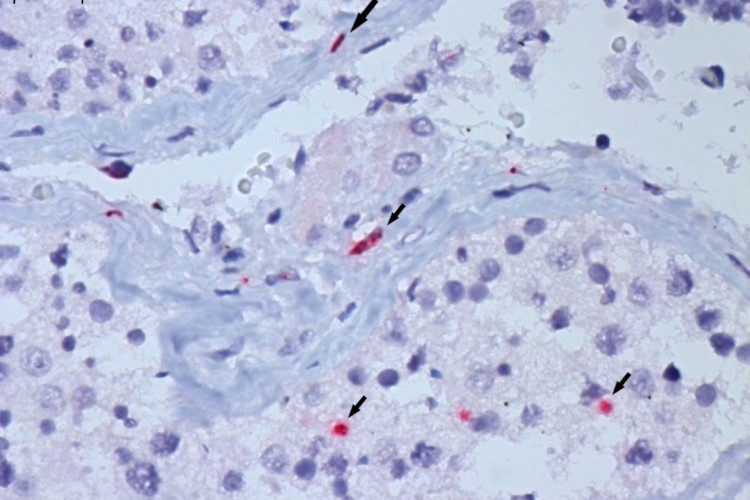 Infecção dupla é chamada de "flurona"; especialistas reforçam importância da vacinação para prevenir contágio