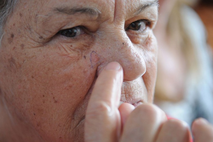 Brasileiros devem redobrar cuidados no verão contra câncer de pele