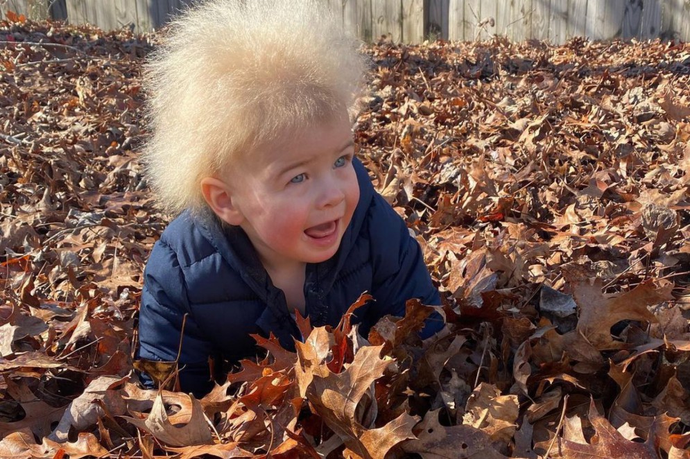 Criança diagnosticada com síndrome do cabelo que não se penteia vira  sucesso nas redes sociais - SIC