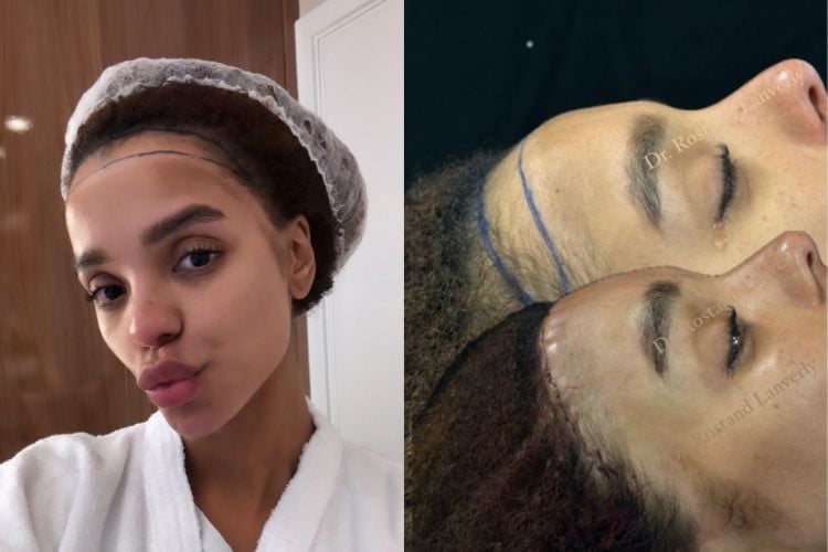 Ex-BBB e esposa de Ludmilla, a bailarina Brunna Gonçalves chamou a atenção nas redes sociais por polêmica cirurgia estética no rosto 

