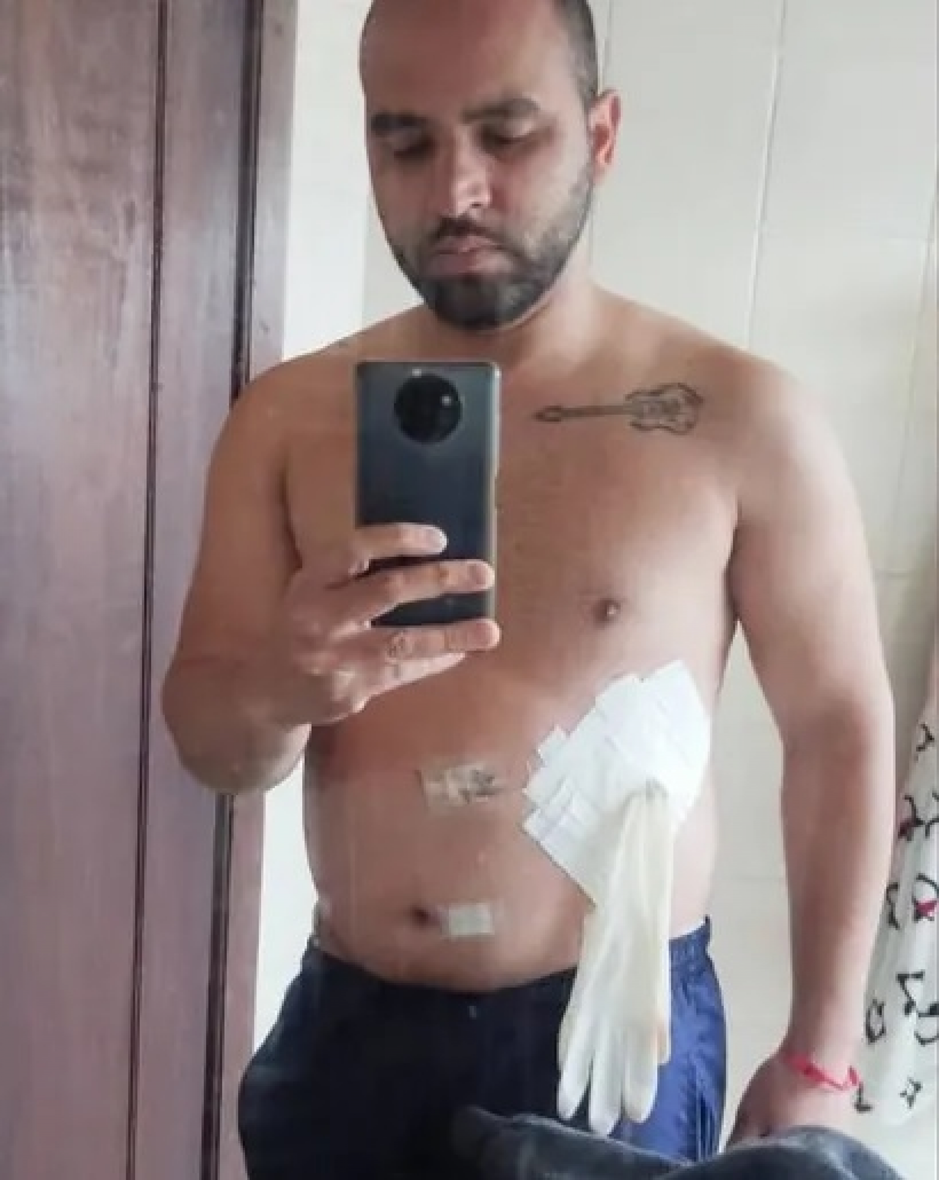 Hospital não tinha bolsas de colostomia no estoque 